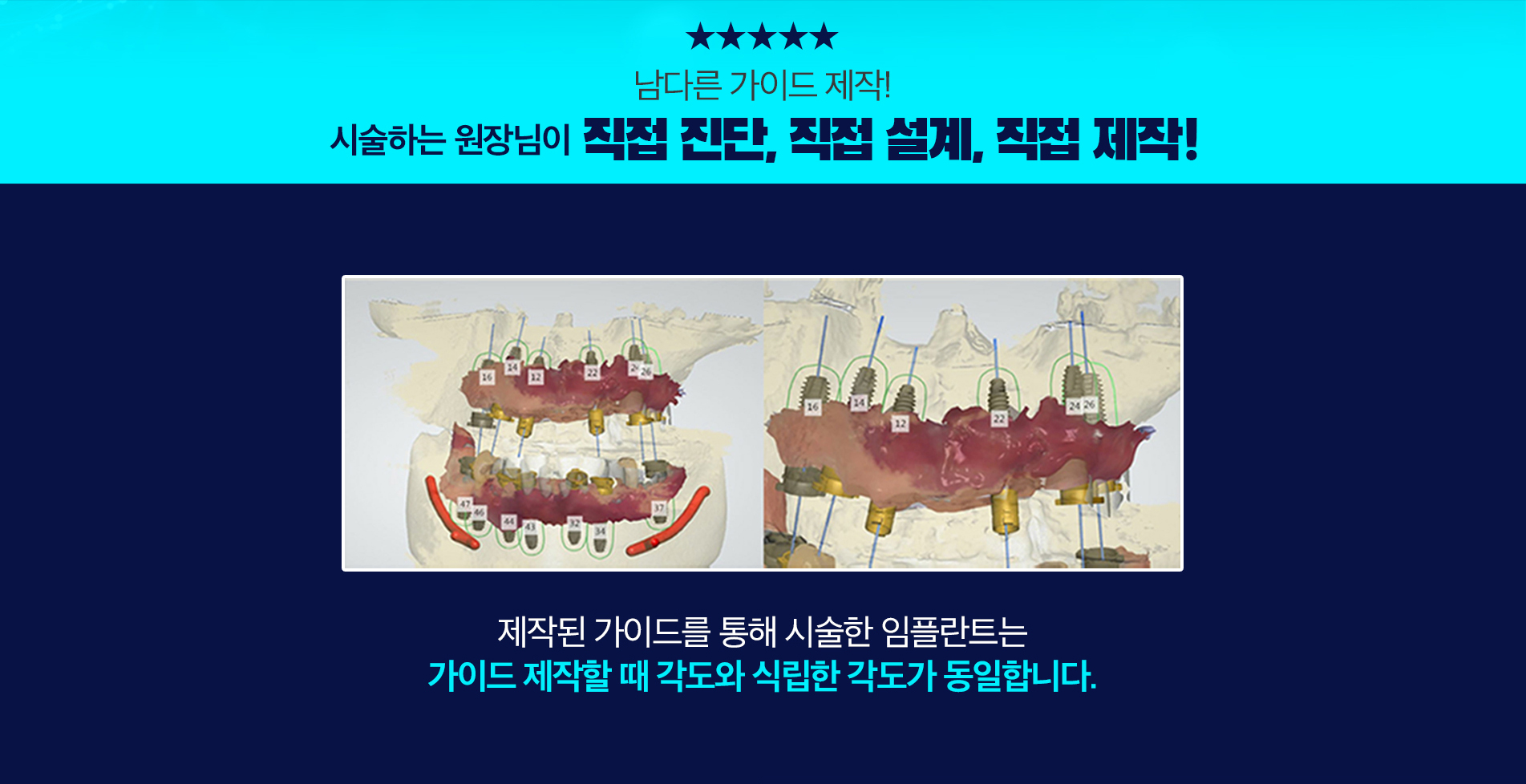 뼈이식 무료, 네이게이션 무료