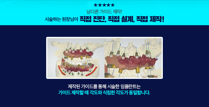 뼈이식 무료, 네이게이션 무료